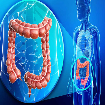 بیماری کولیت اولسراتیو