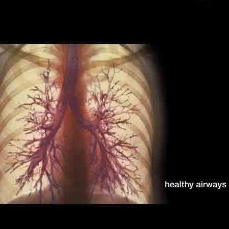 بیماری مزمن انسداد ریوی (COPD)