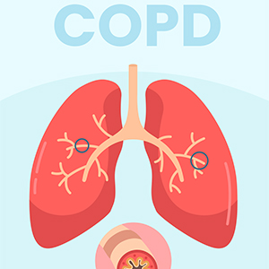 بیماری مزمن انسداد ریوی (COPD)